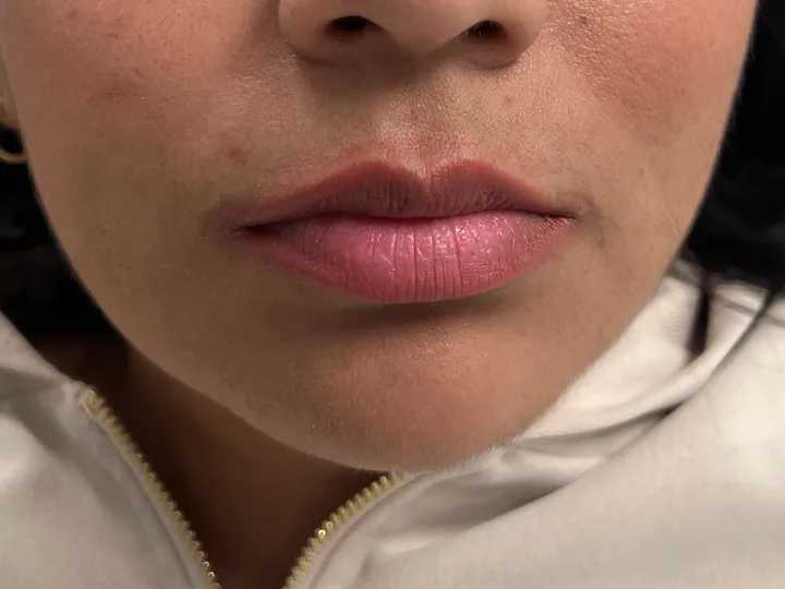 Labios antes del aumento con Vasilii Artemev, vista frontal