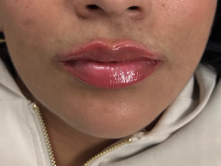 Labios inmediatamente después del aumento con Vasilii Artemev, vista frontal