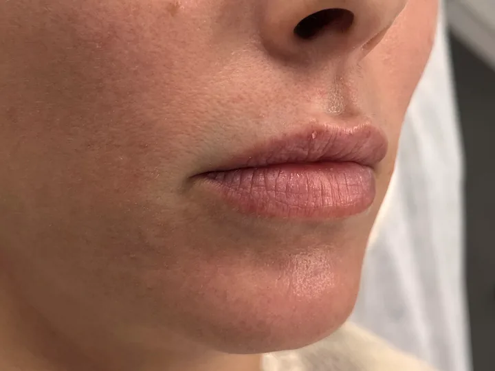 Labios antes del aumento con Vasilii Artemev, vista de tres cuartos