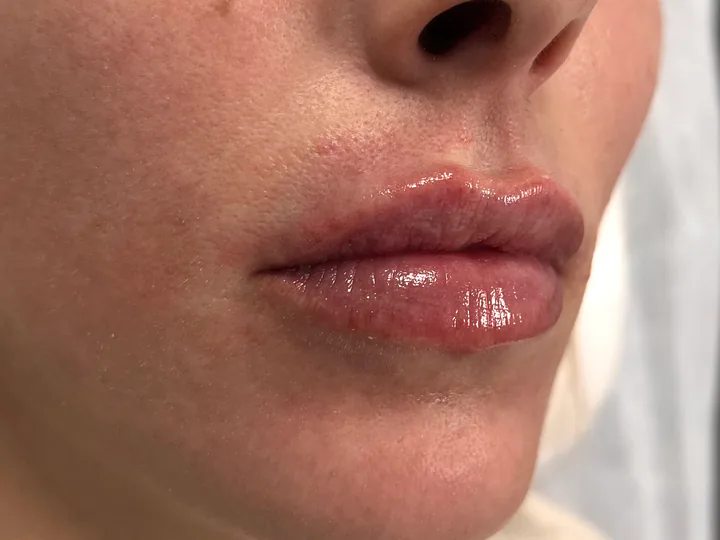 Labios inmediatamente después del aumento con Vasilii Artemev, vista de tres cuartos