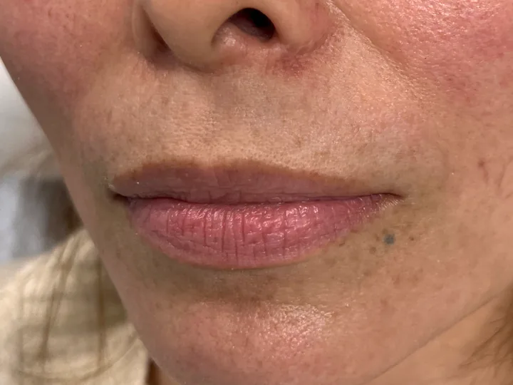 Labios antes del aumento con Vasilii Artemev, vista frontal