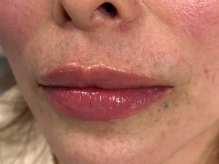 Labios inmediatamente después del aumento con Vasilii Artemev, vista frontal