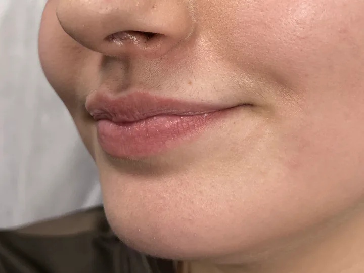 Labios antes del aumento con Vasilii Artemev, vista de tres cuartos