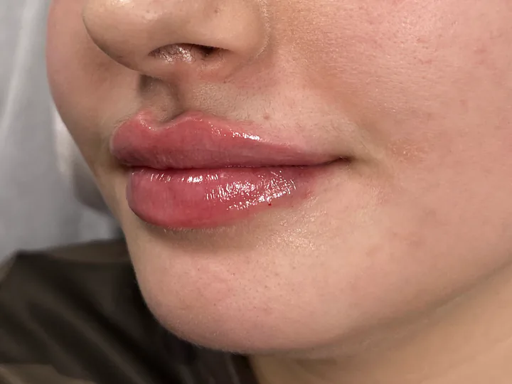 Labios inmediatamente después del aumento con Vasilii Artemev, vista de tres cuartos