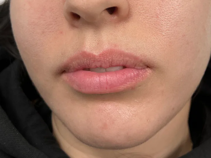 Labios antes del aumento con Vasilii Artemev, vista frontal