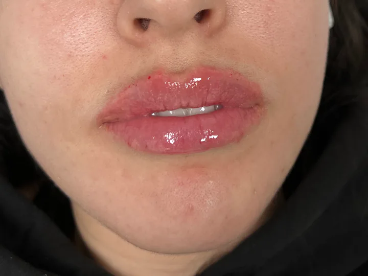 Labios inmediatamente después del aumento con Vasilii Artemev, vista frontal